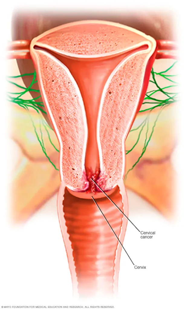 what is cervical cancer